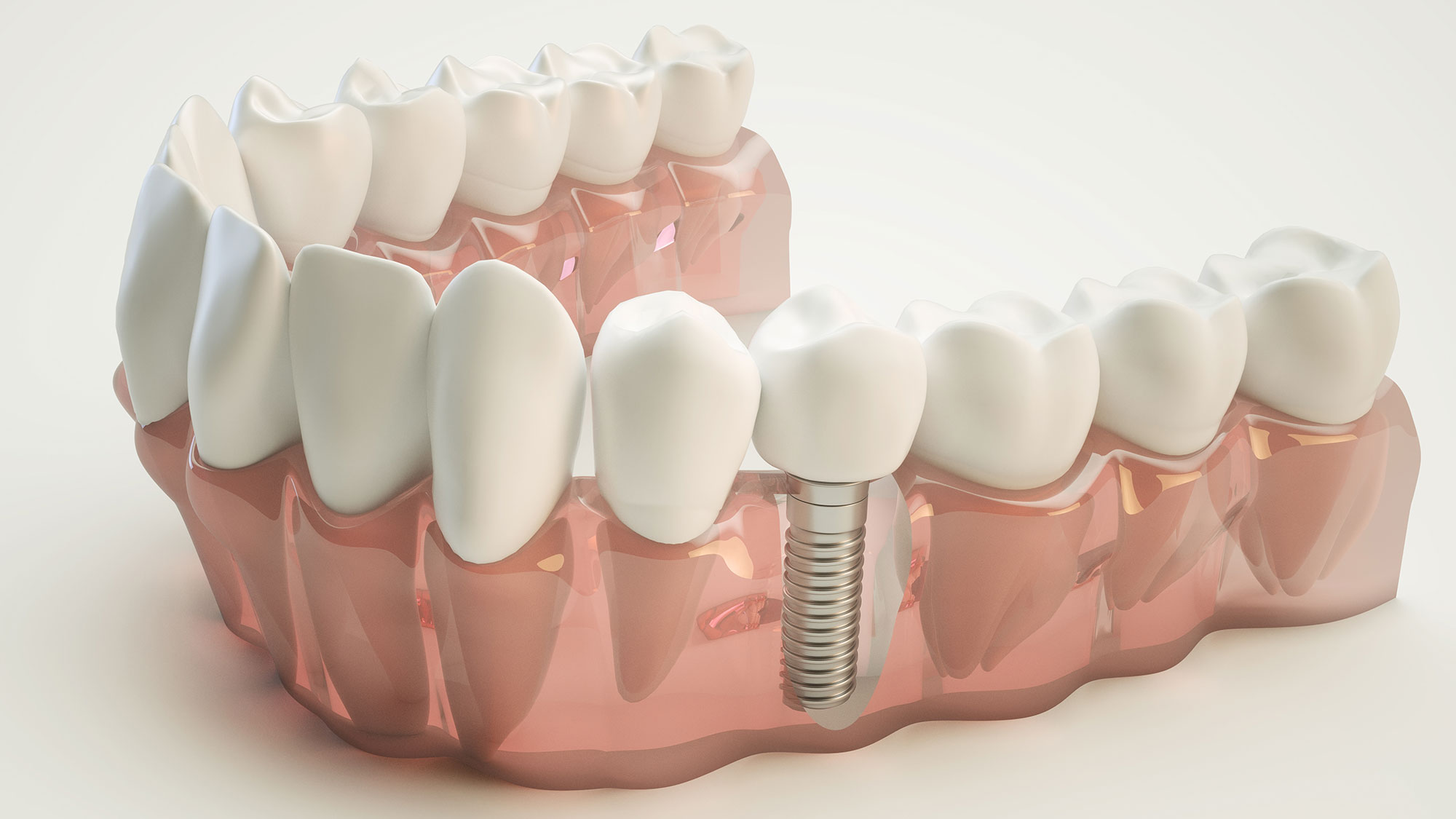 Dental Implant Van Nuys, CA