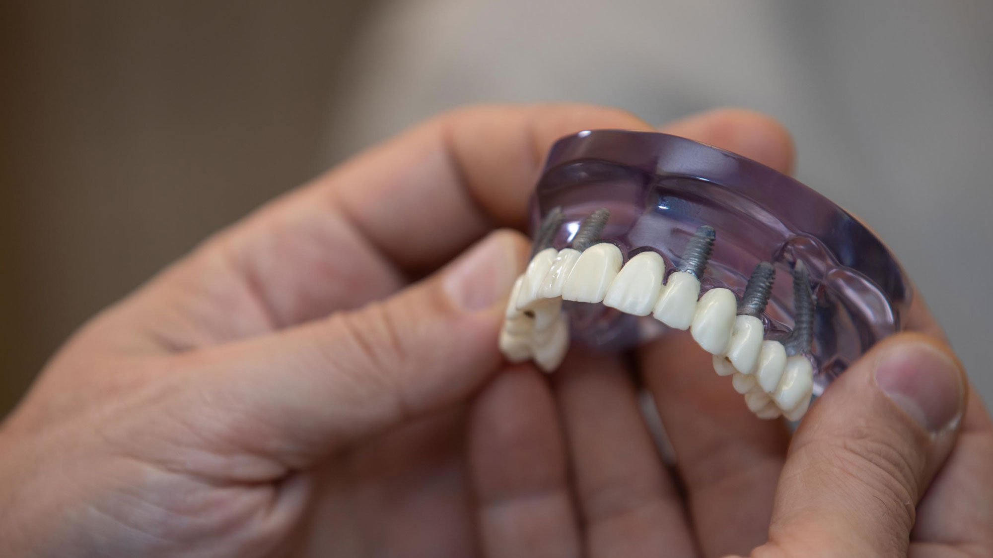 Full Arch Dental Implants Van Nuys, CA