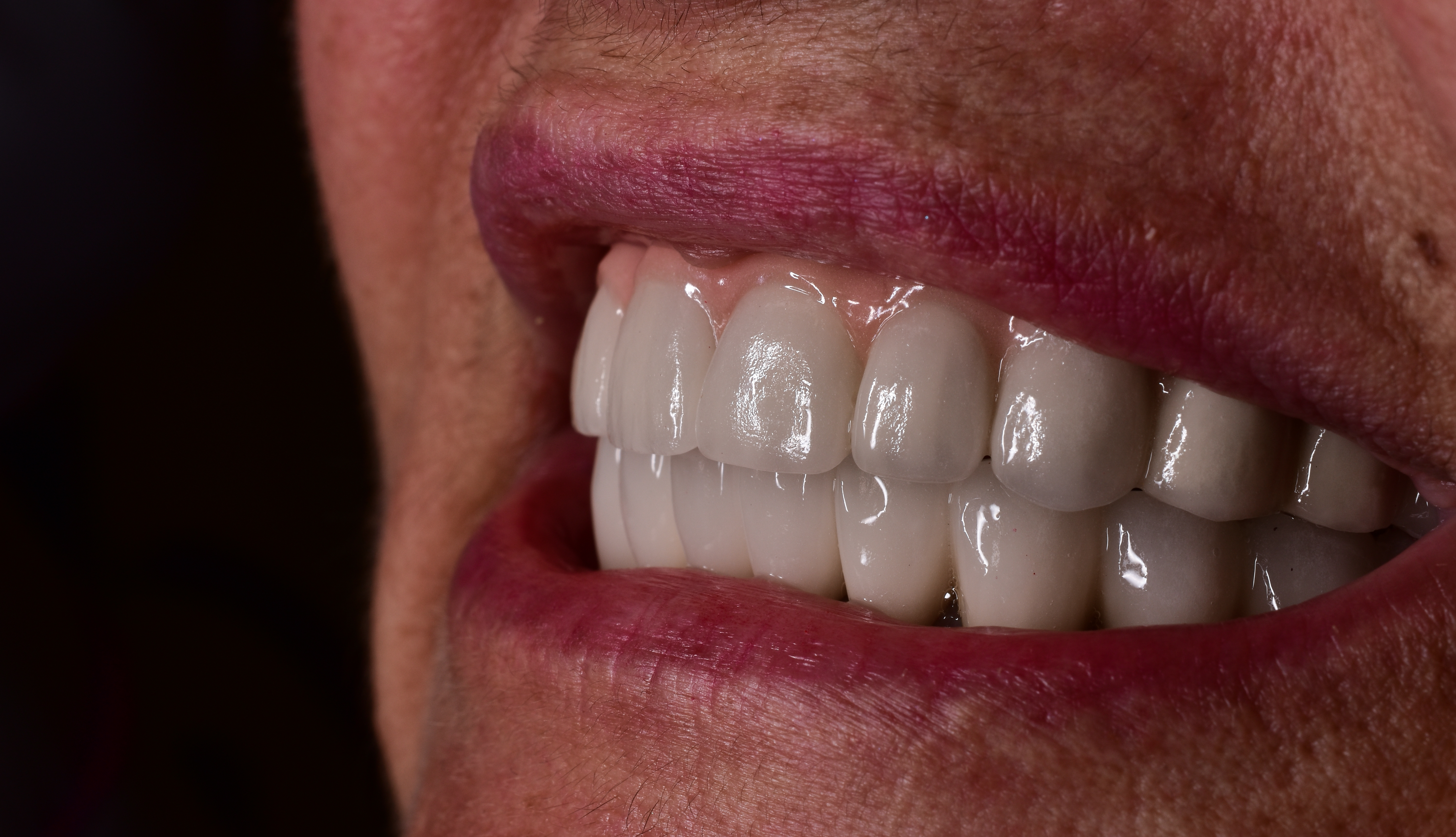 Does a Dental Implant Feel Normal?