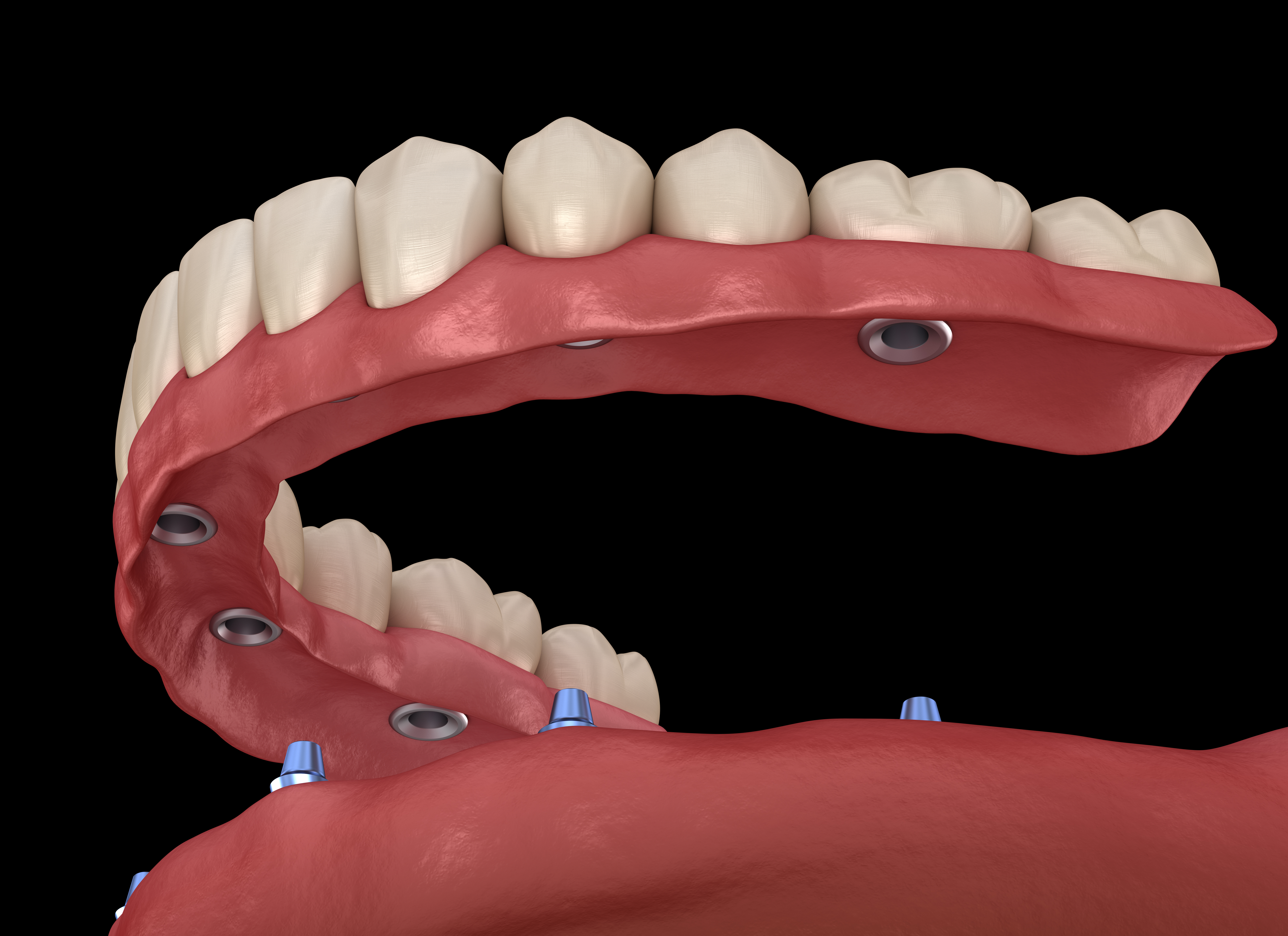 implant supported dentures van nuys ca