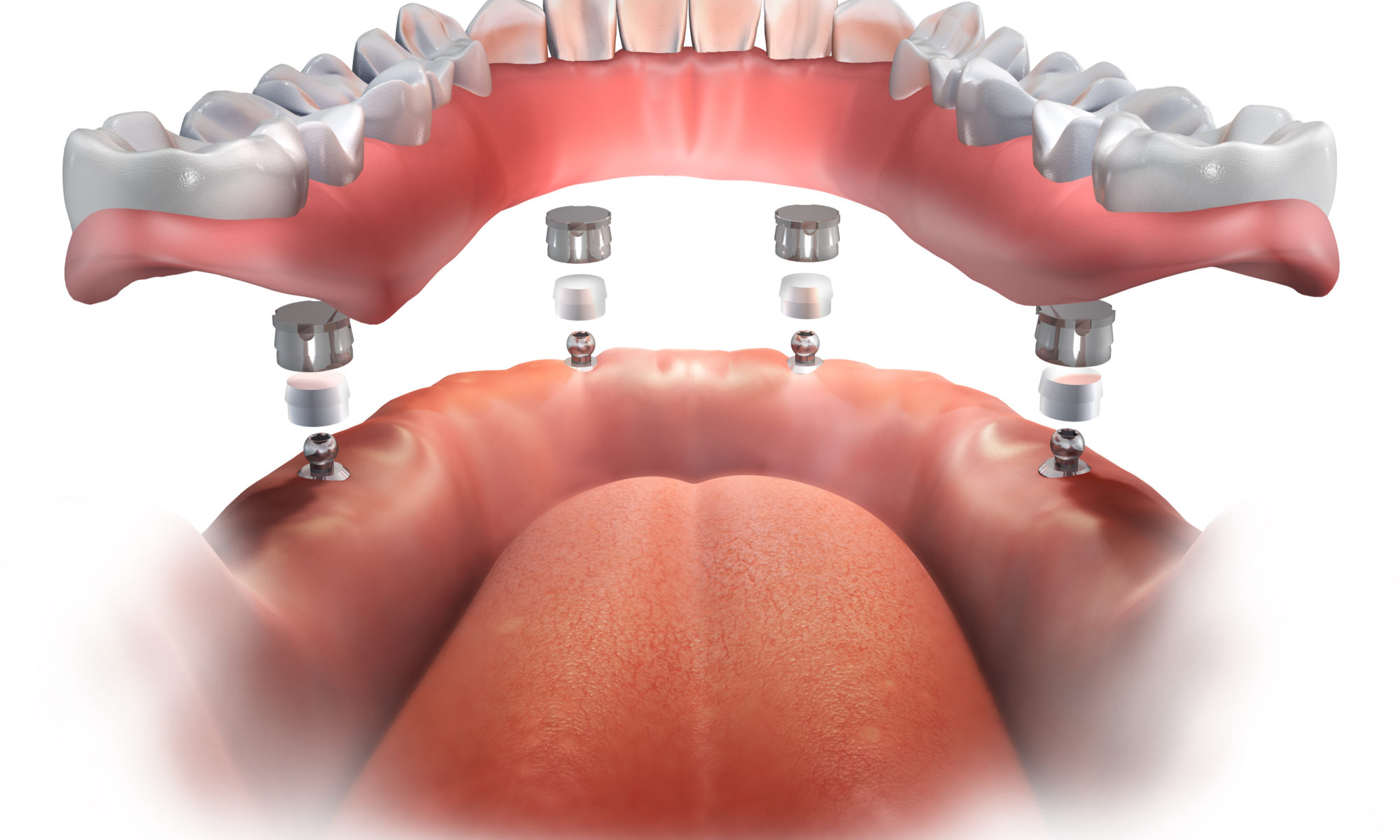 implant supported dentures van nuys ca