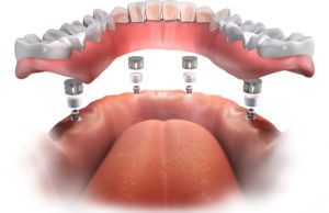 implant supported dentures van nuys ca