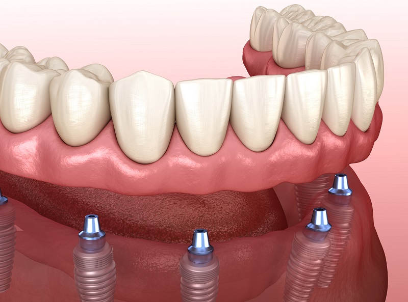 implant supported dentures north hills ca