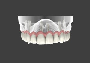 full arch dental implants van nuys ca