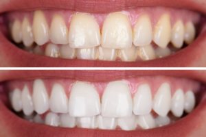 teeth whitening van nuys ca