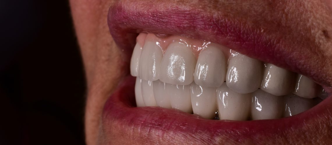 dental implants north hills ca