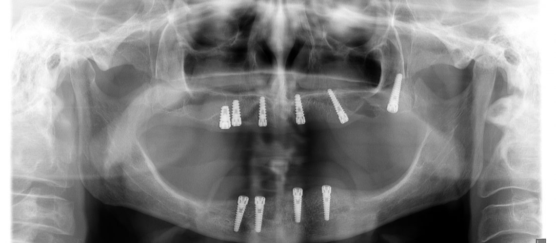 dental implants panorama city ca