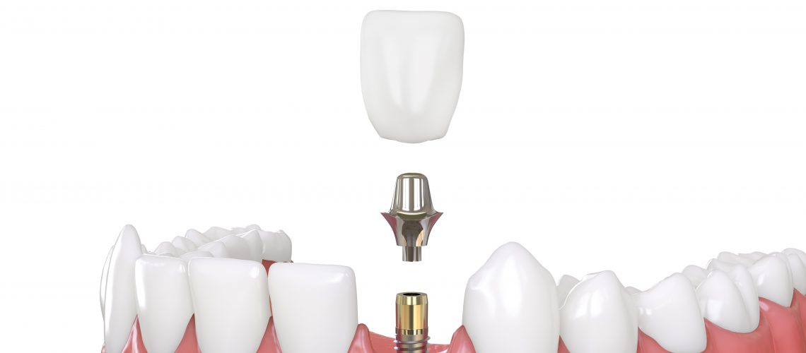 dental implants van nuys ca