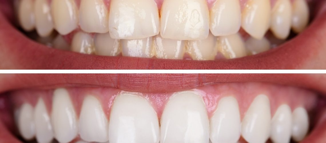 teeth whitening van nuys ca