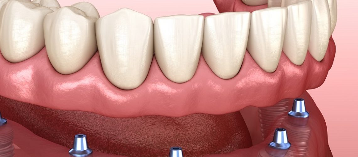 implant supported dentures north hills ca