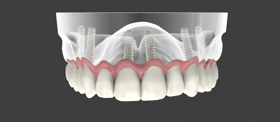 full arch dental implants van nuys ca
